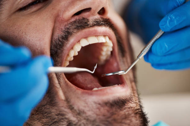 Emergency Dental Filling Replacement in GA